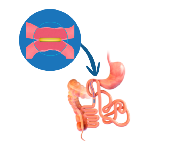 Weight loss with Magnets
